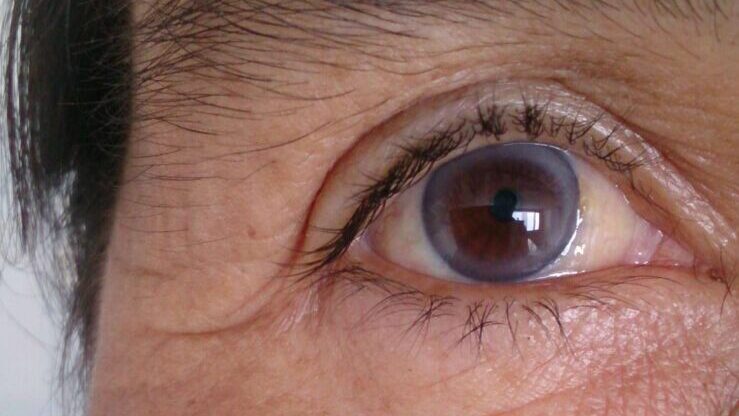 Increased Discoloration of The Eye - infection
