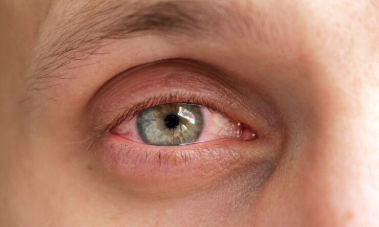 Pink Eye causes and symptoms