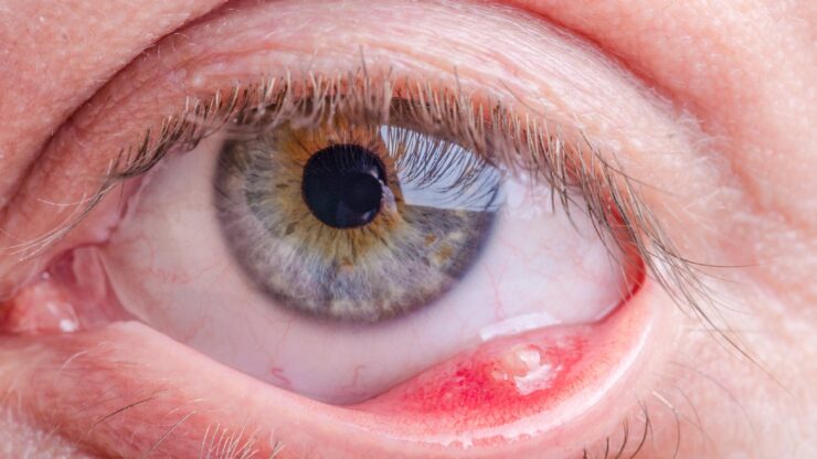 Possible Eye Infection - eye Swelling