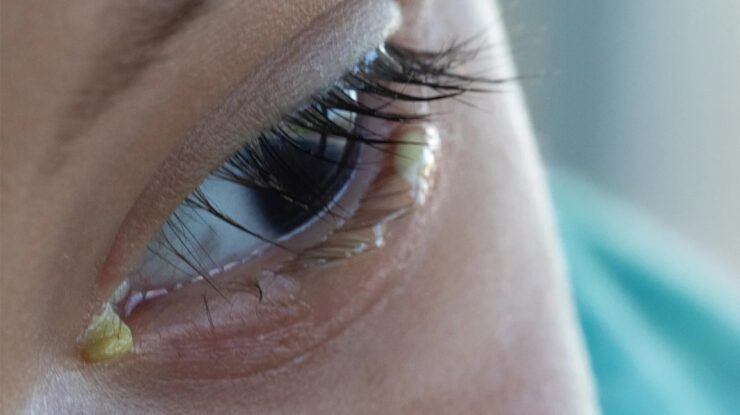 eye Discharge - symptoms